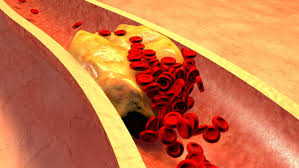 arterial plaques