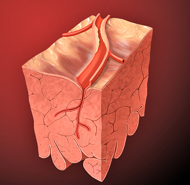 dyslipidemia