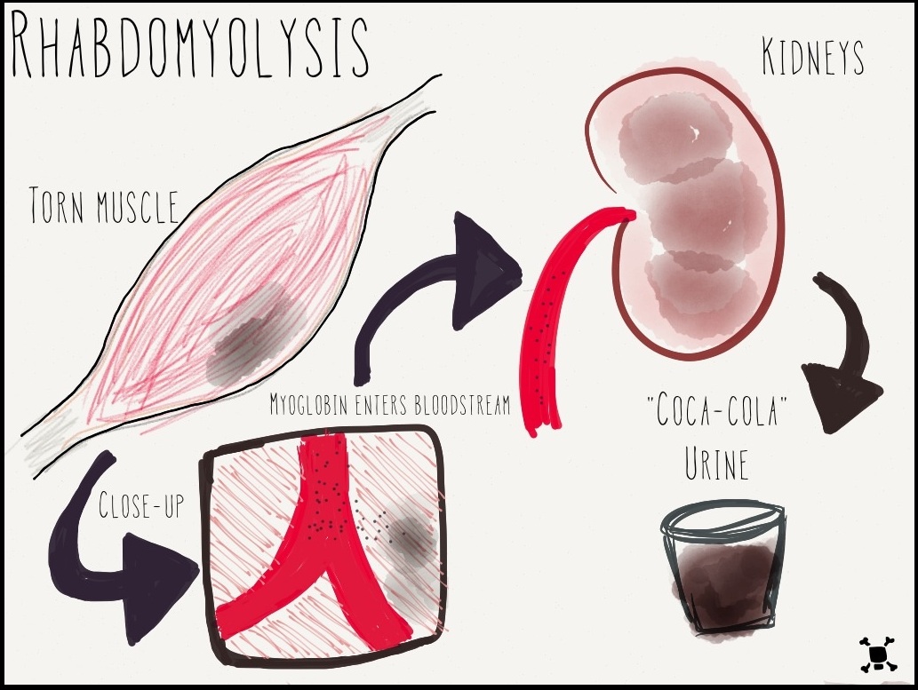 Rhabdomyolysis 