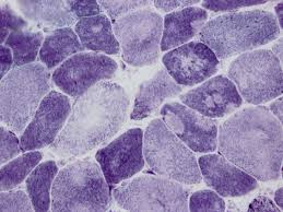 vascular myopathy cells
