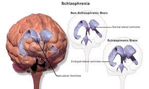 schizophrenia in the brain