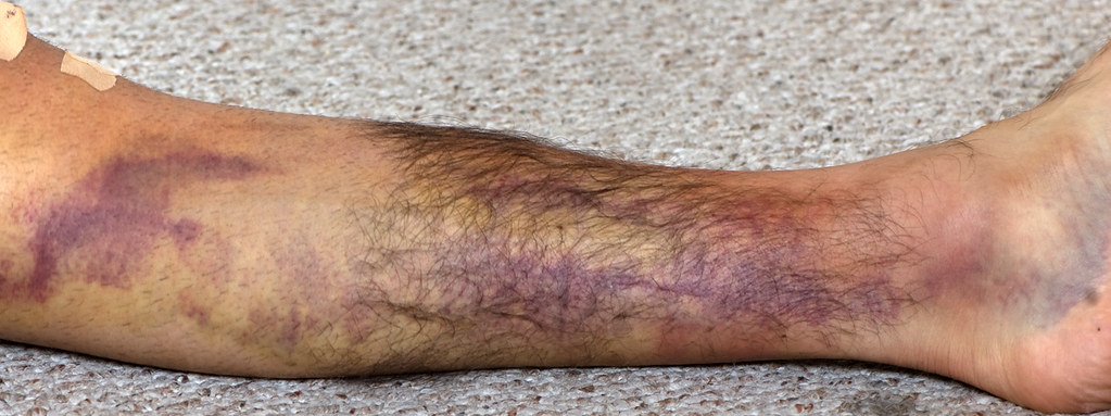 bruising on the leg