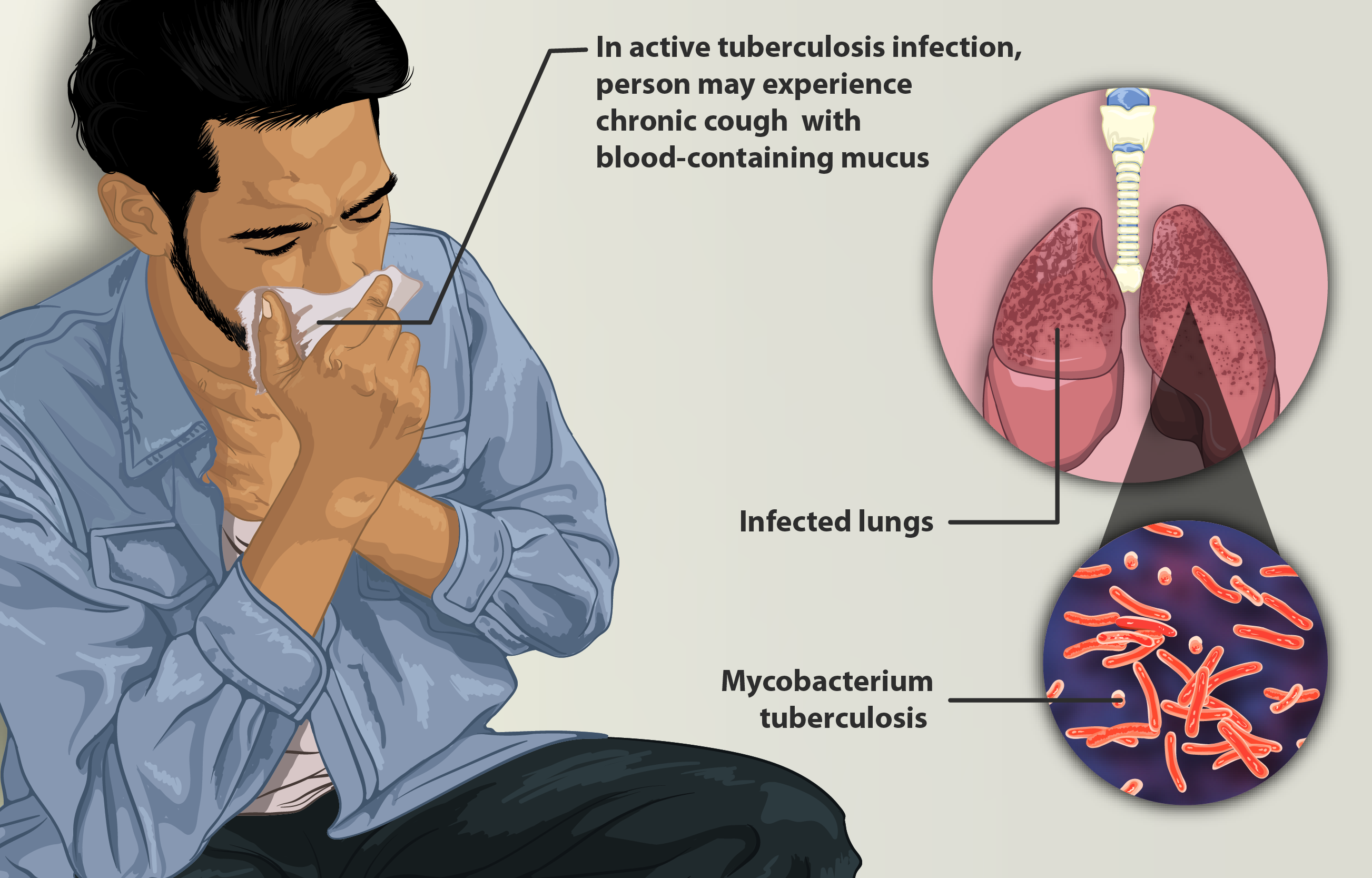 person with tuberculosis