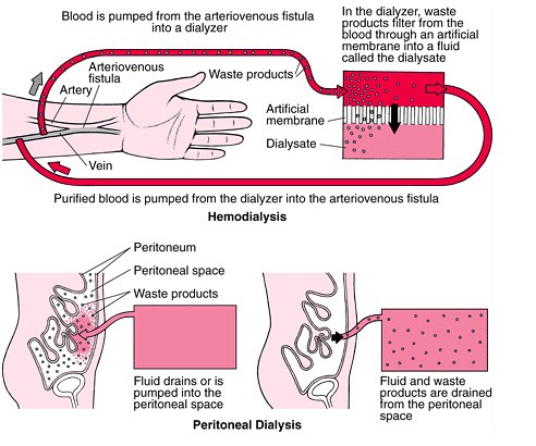 hemodialysis