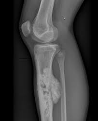 osteosarcoma bone xray