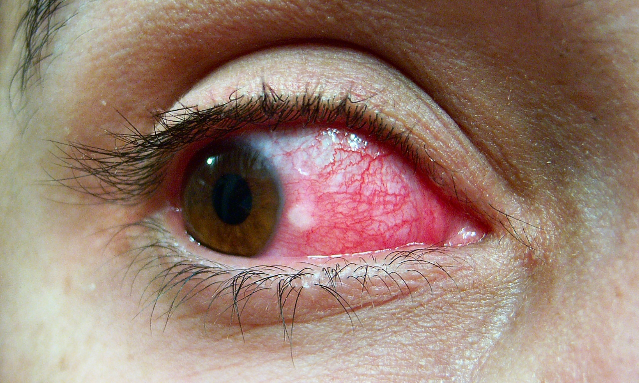 red and itchy eye