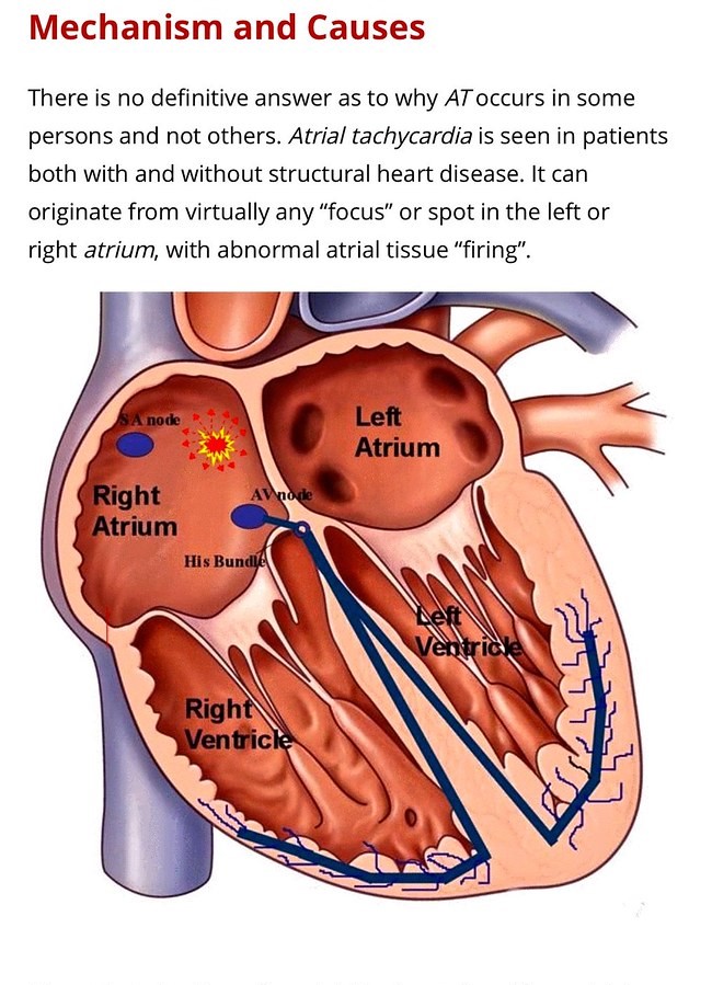 tachycardia