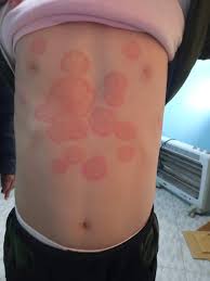 tinea corporis on a kids back