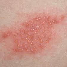 rash with blisters