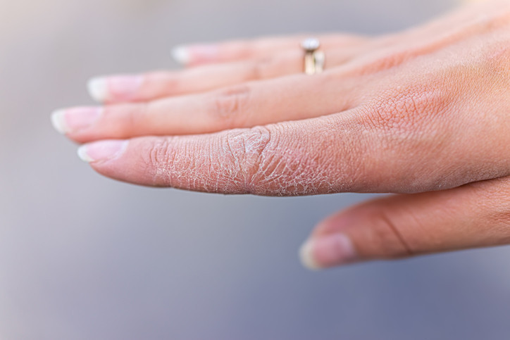 dry skin on the finger