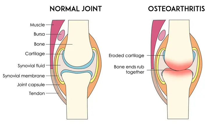 osteoarthritis