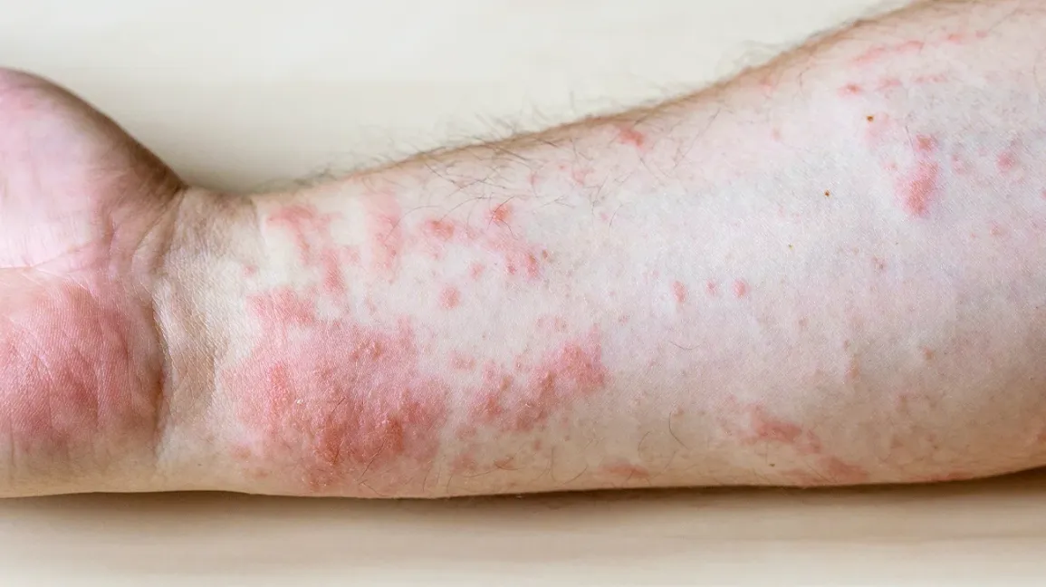 hand with rash
