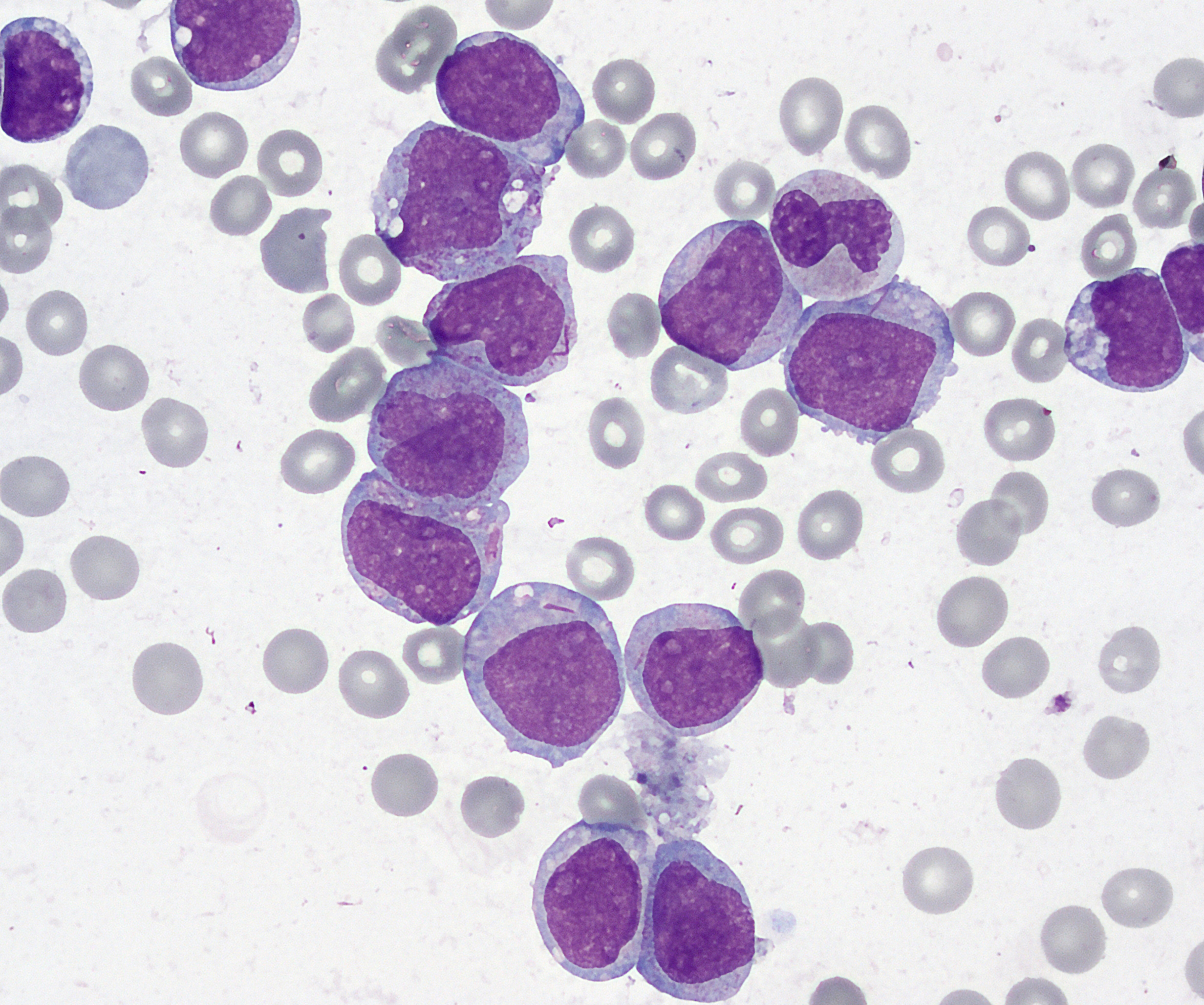 Acute Myeloid Leukemia