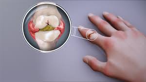 rheumatoid arthritis in the finger