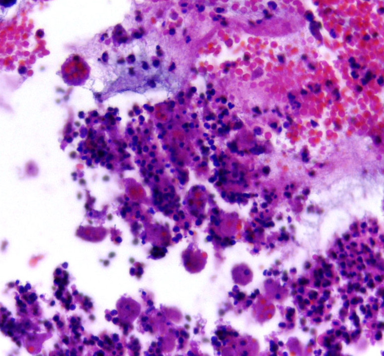 amoebiasis