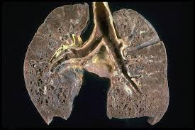 sarcoidosis of the lungs