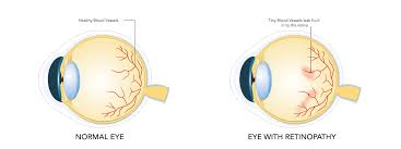 retinopathy