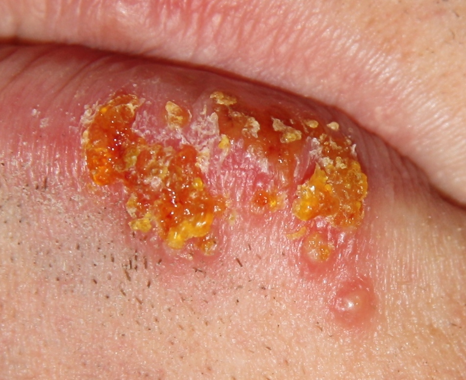 Herpes labialis