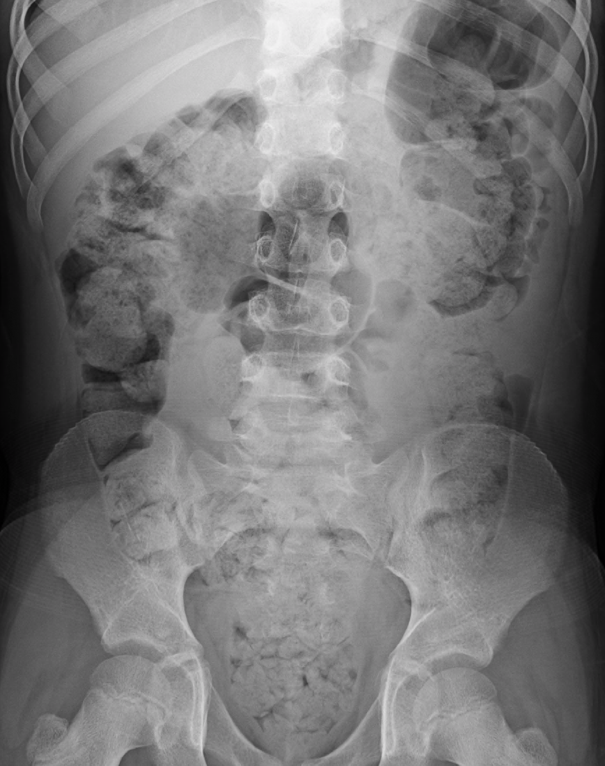 constipated on xray