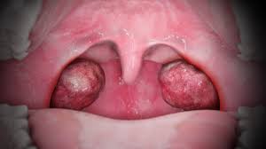 tonsillitis in the throat