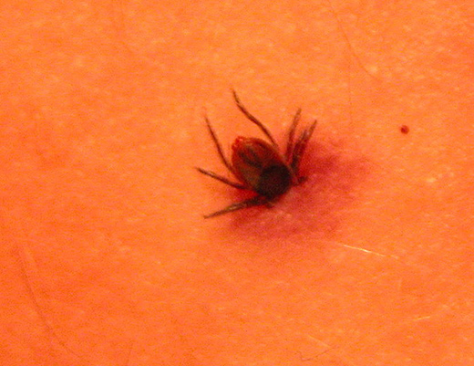tick that causes lyme disease
