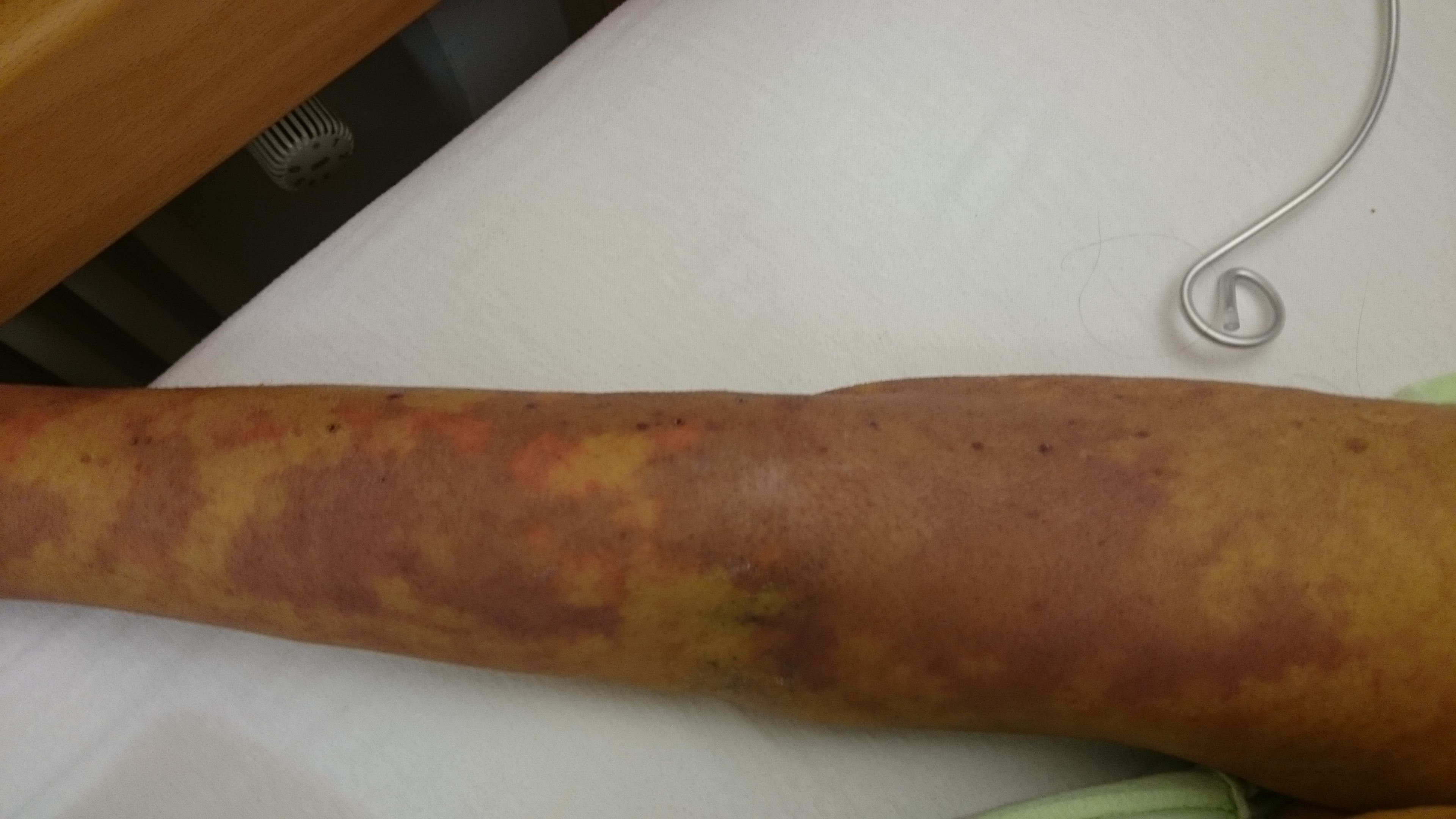 sepsis in the limb
