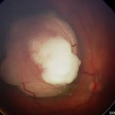 retinoblastoma cancer of the eye