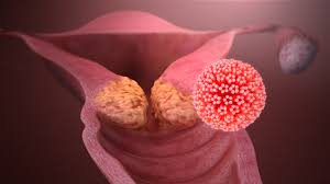 cervical cancer metastatic