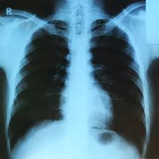 x ray of lungs