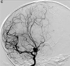 brain angiography