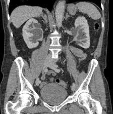 pelvis urography