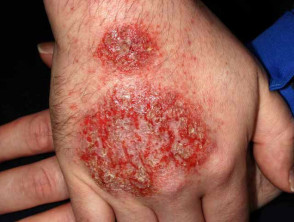 cutaneous candidiasis on top of hand