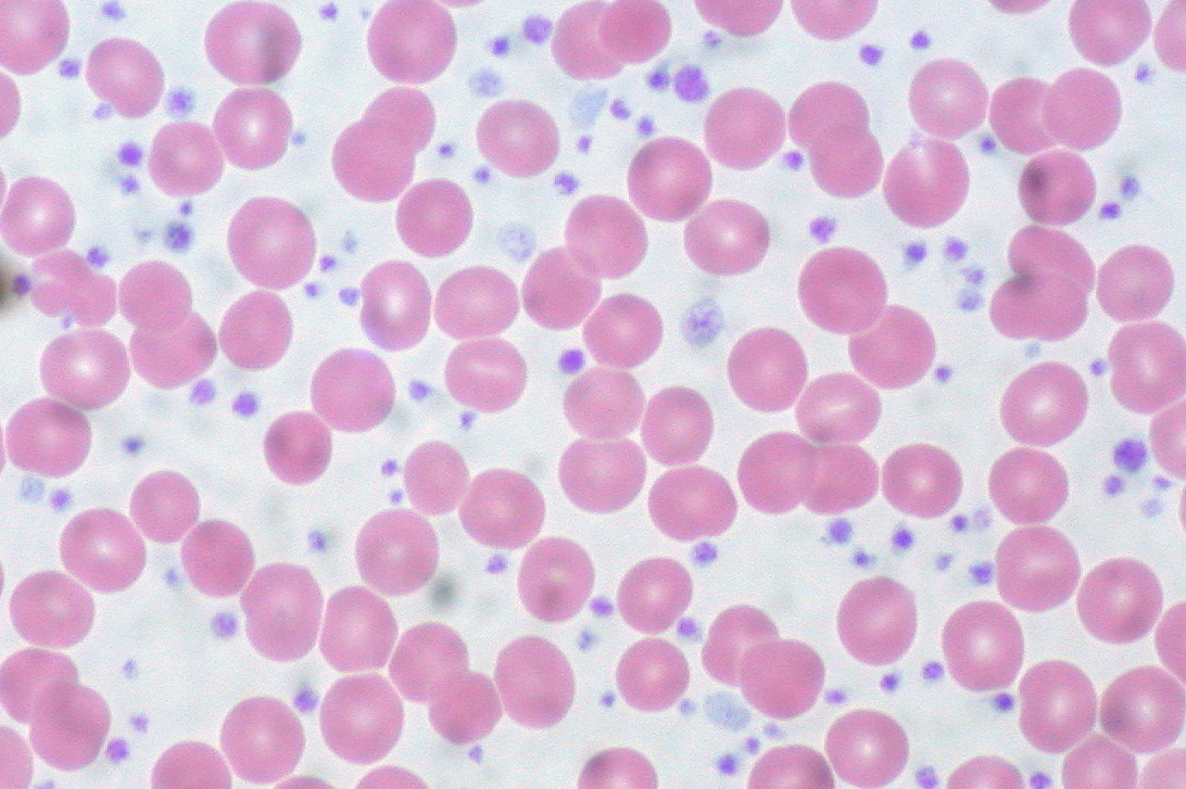 Thrombocytopenia	