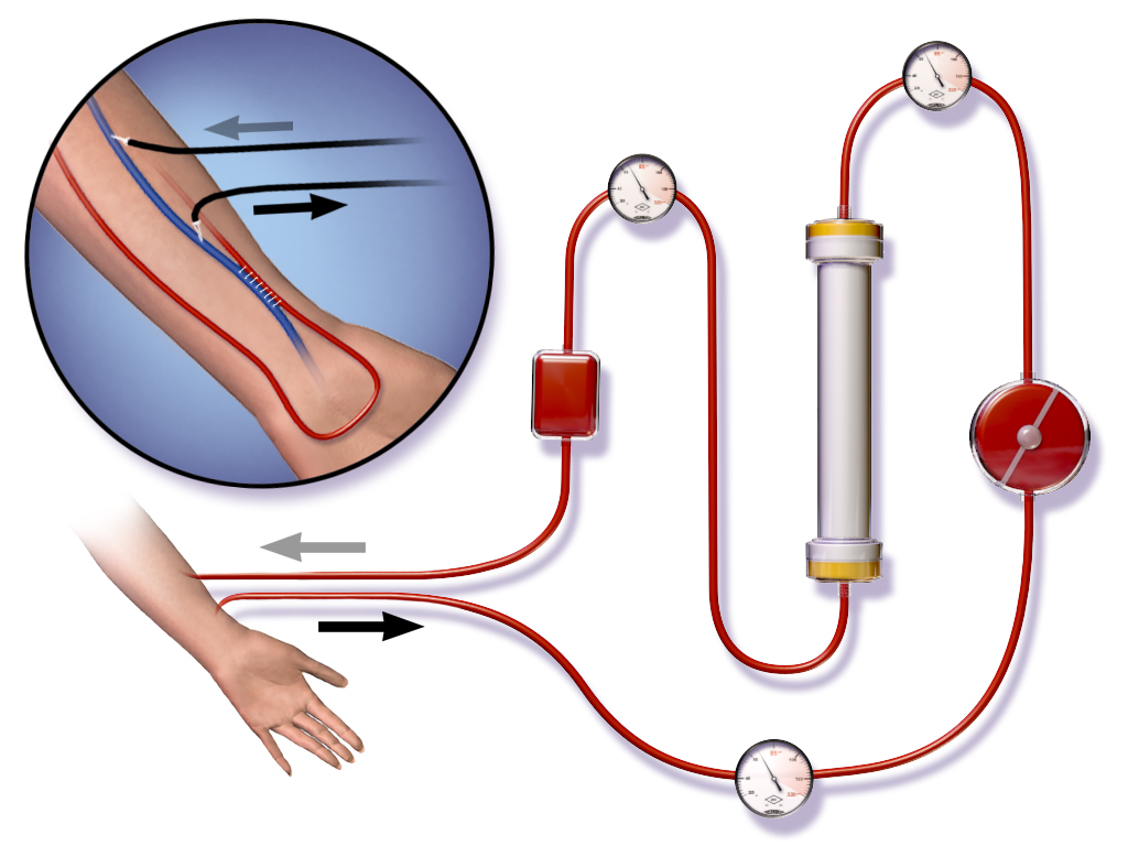 hemodialysis procedure