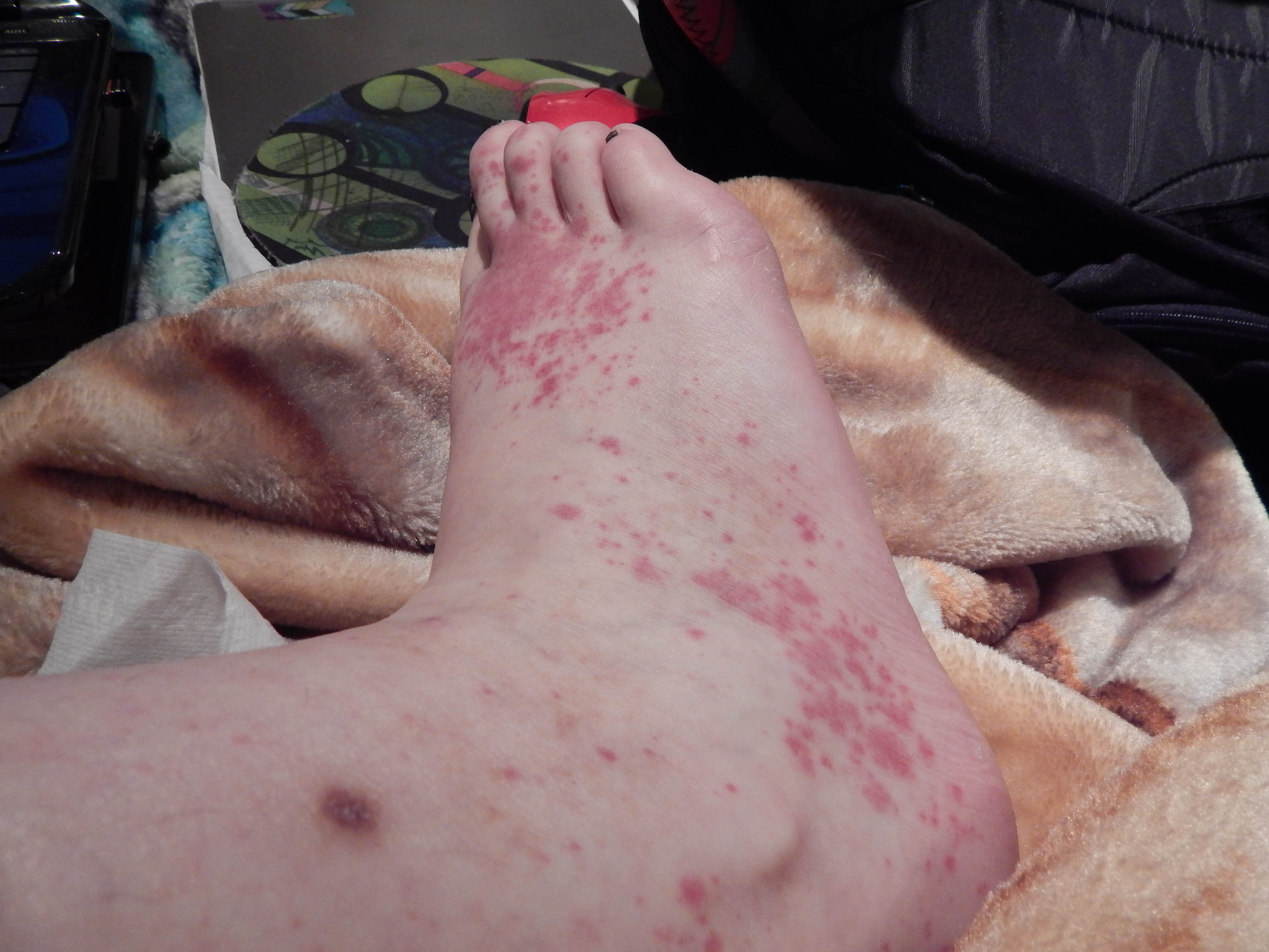 Idiopathic Urticaria