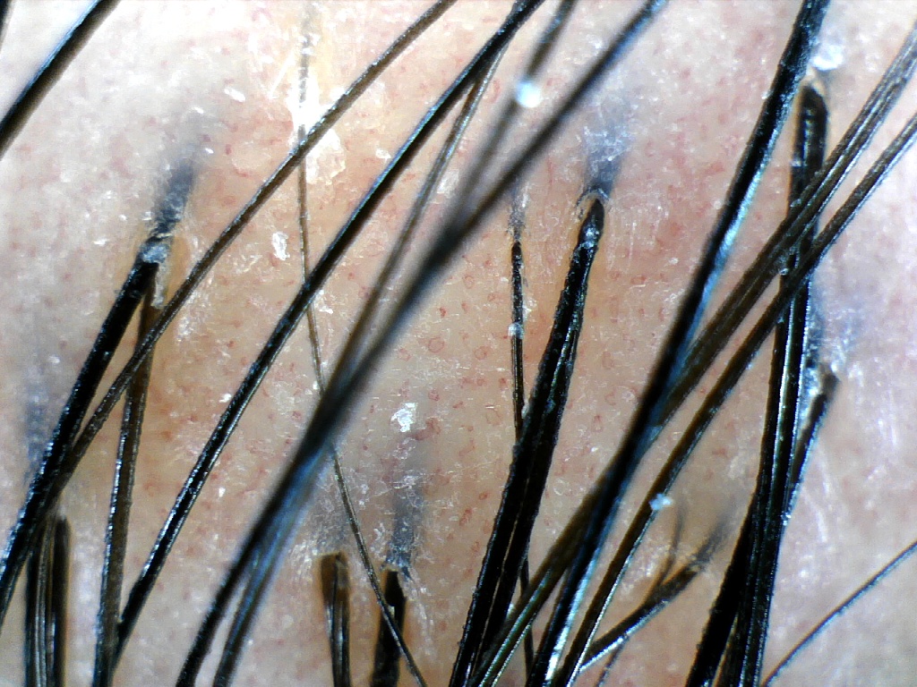 close up of hair follicle