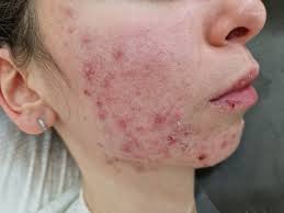 acne on cheek