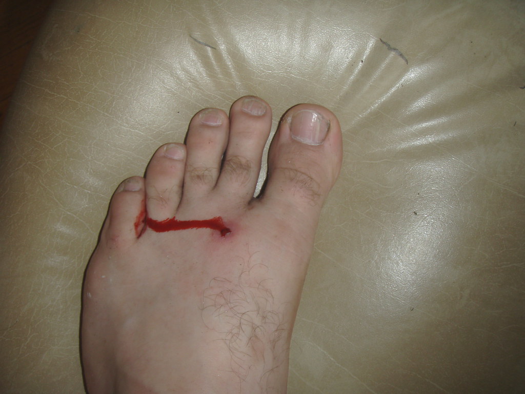 open wound