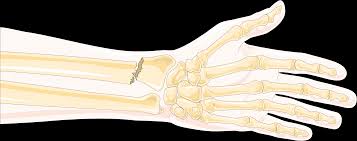 bone fracture of the arm