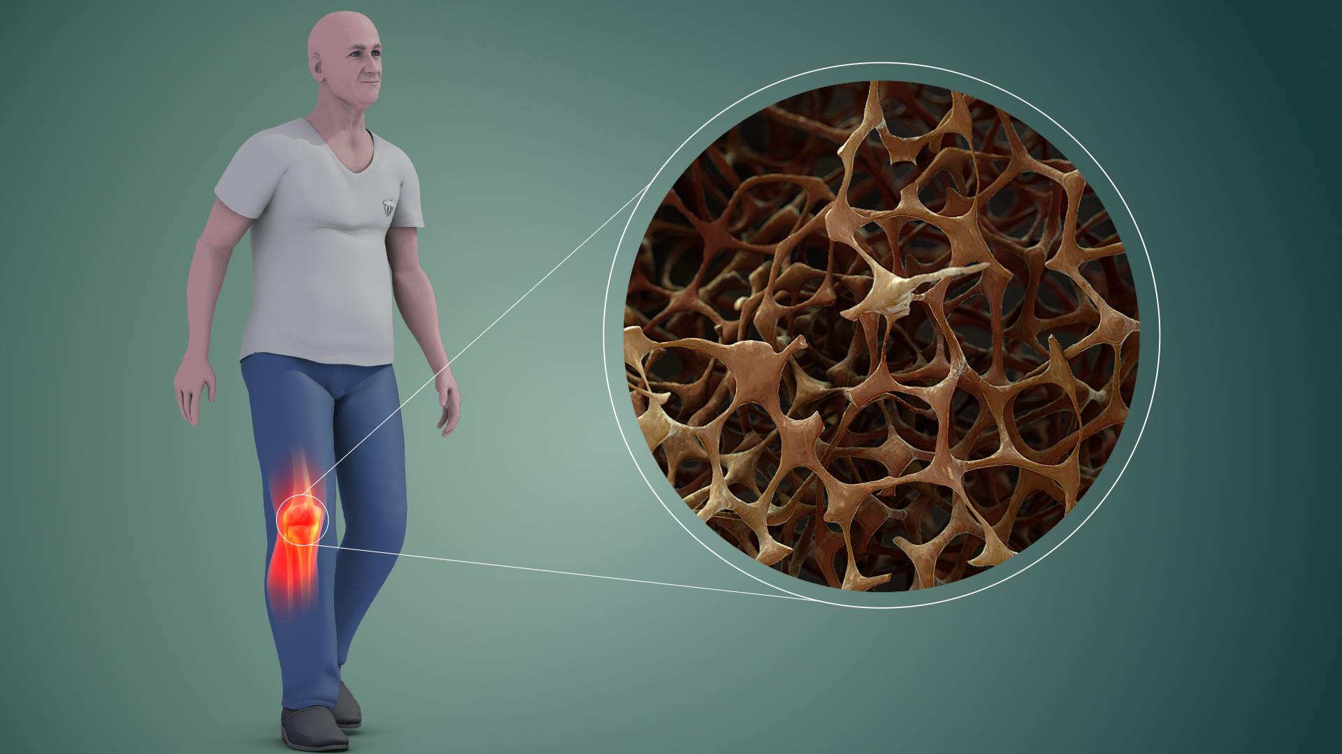 osteoporosis close up