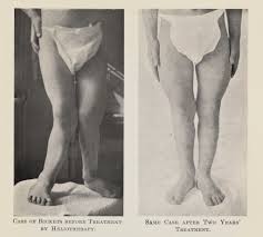 rickets of a young boy