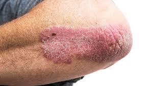 psoriasis on the arm