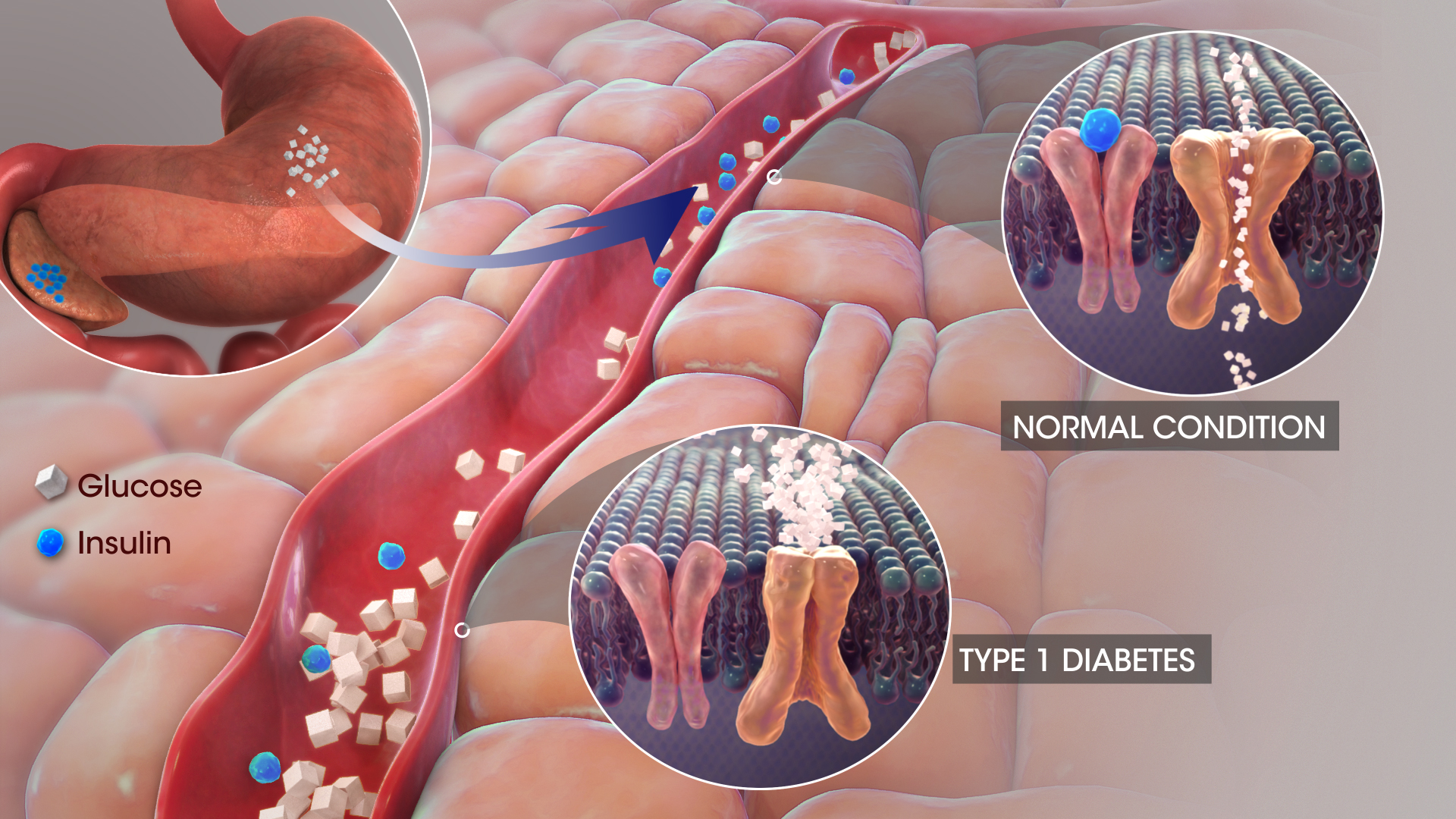 diabetes type 1