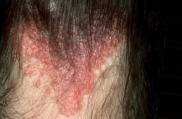 scalp psoriasis