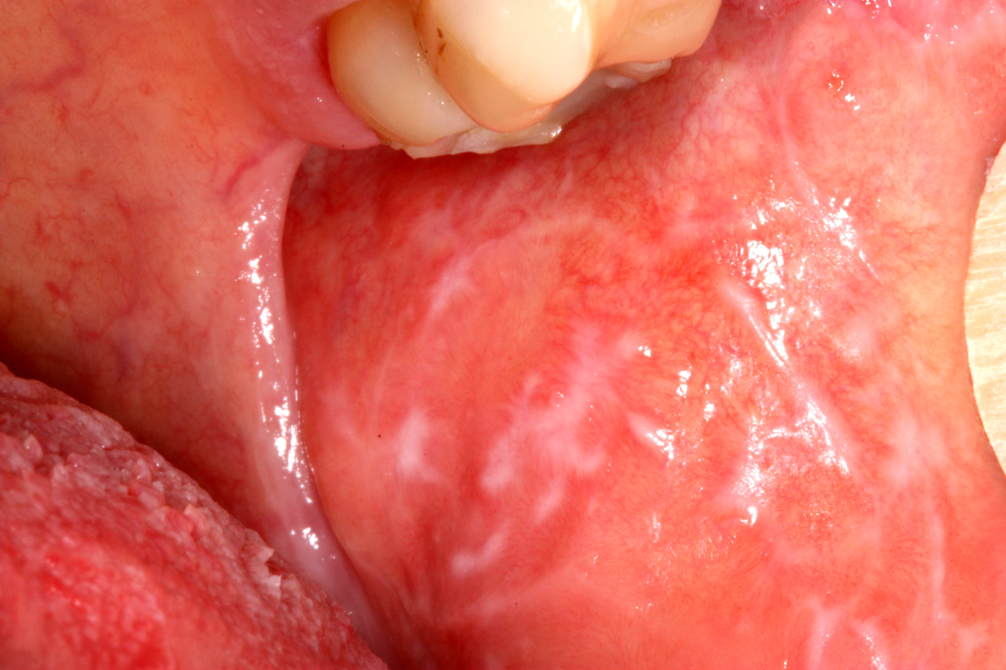 lichen planus on the mouth