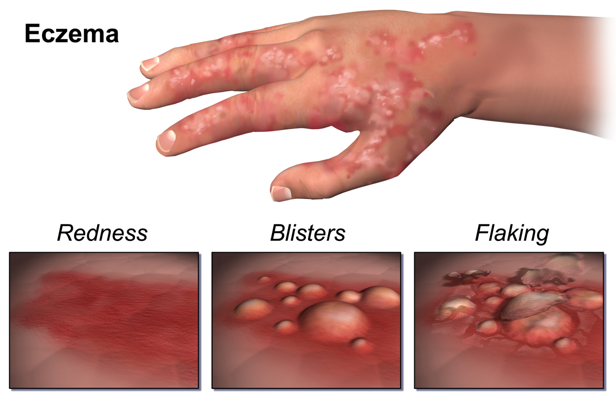 eczema on the arm