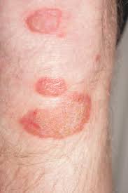 psoriasis on the arm