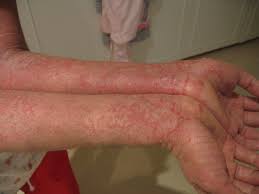eczema on the arm