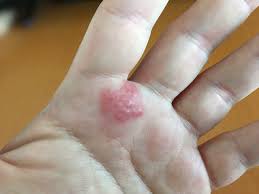 contact dermatitis on side of palm