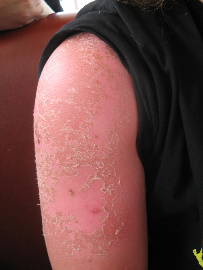 sunburn on the upper part of the arm